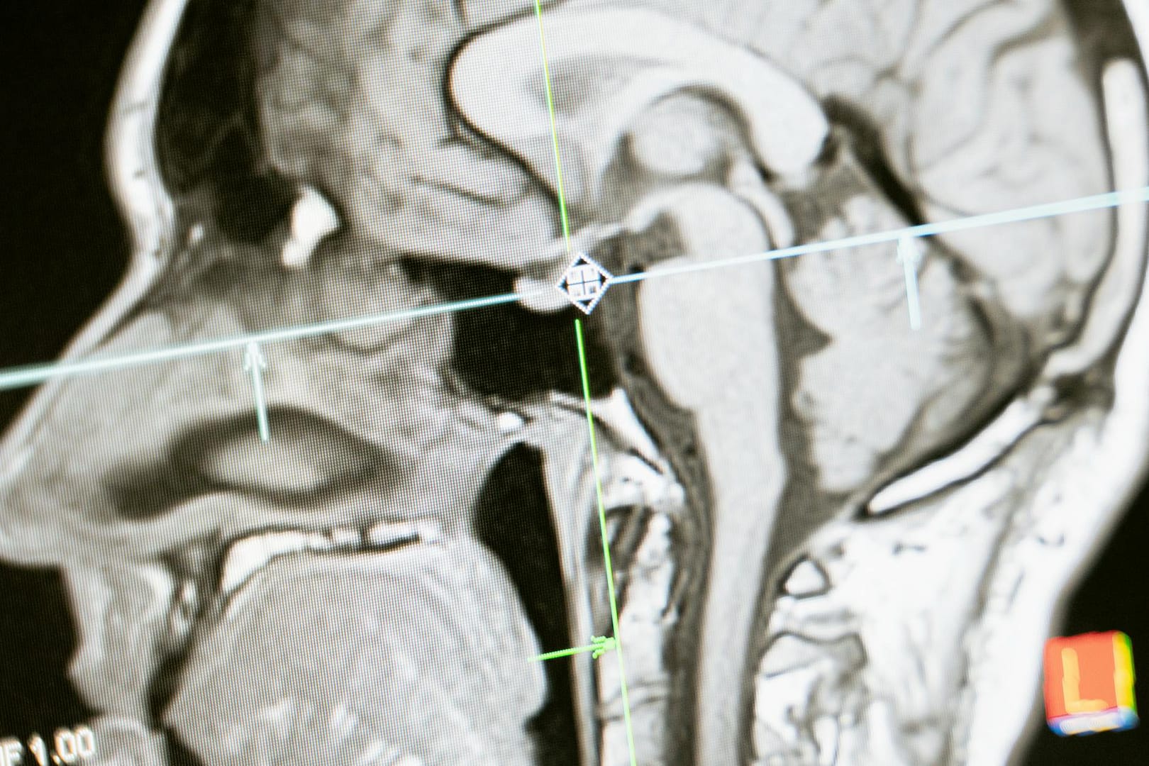 The Miracle of Neuroplasticity: Rewiring Your Brain for Emotional Wellness